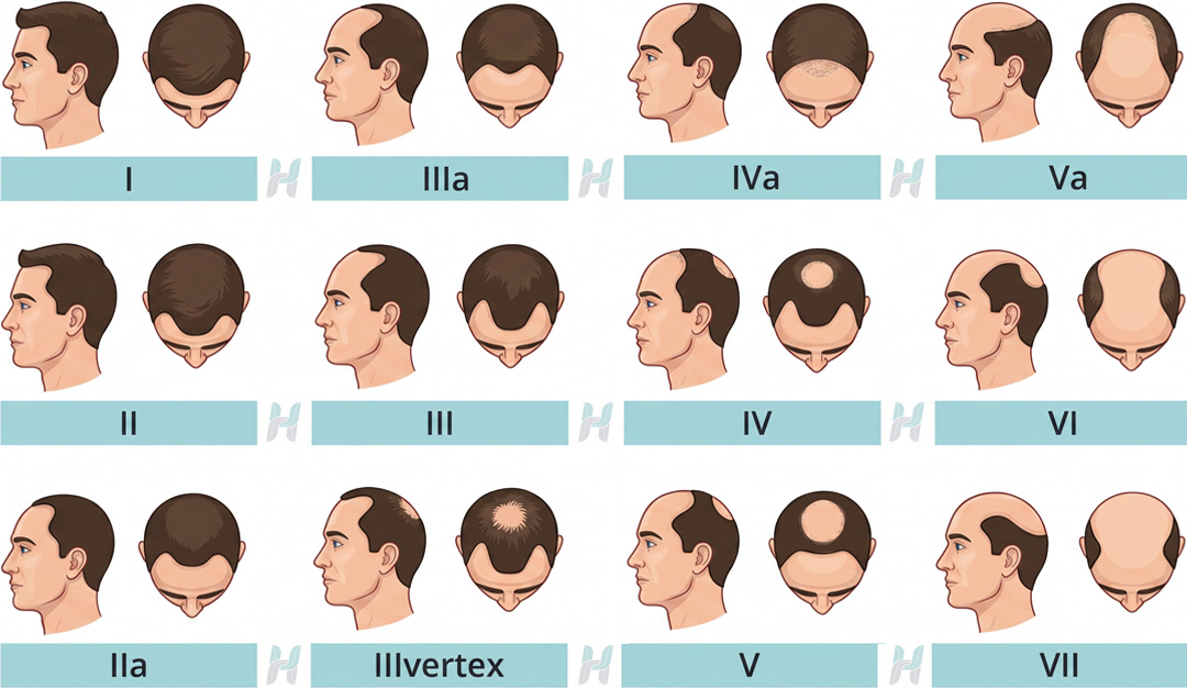 Doctor Hair Clinic - Hamilton-Norwood skála