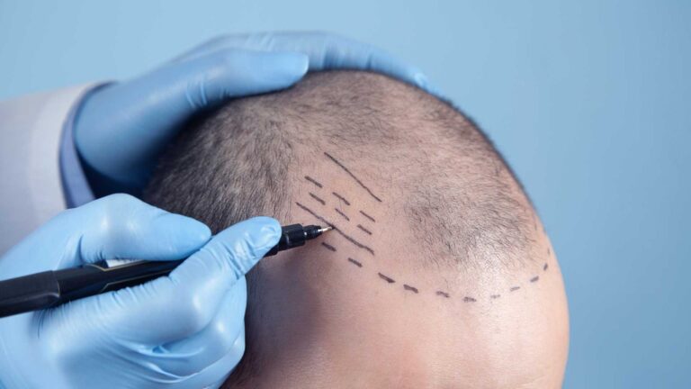 Doctor Hair Clinic Hajbeültetés